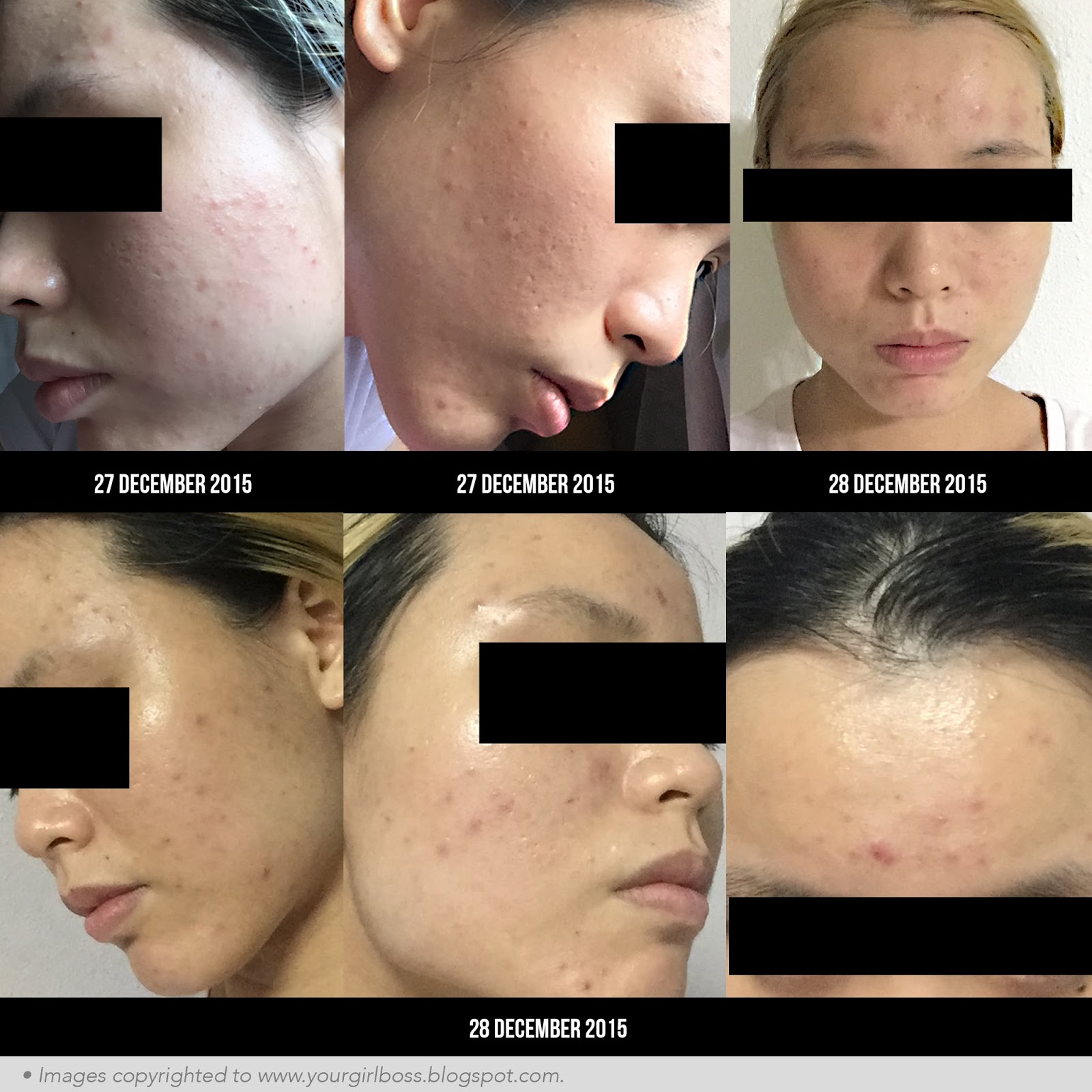 asian acne