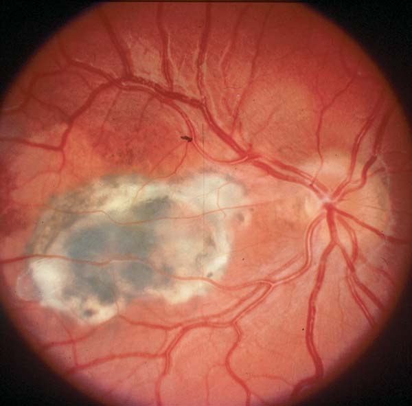 neurofibromatosis