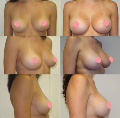 Antes e Depois Mamoplastia de Aumento Antes e Depois Mamoplastia de Aumento