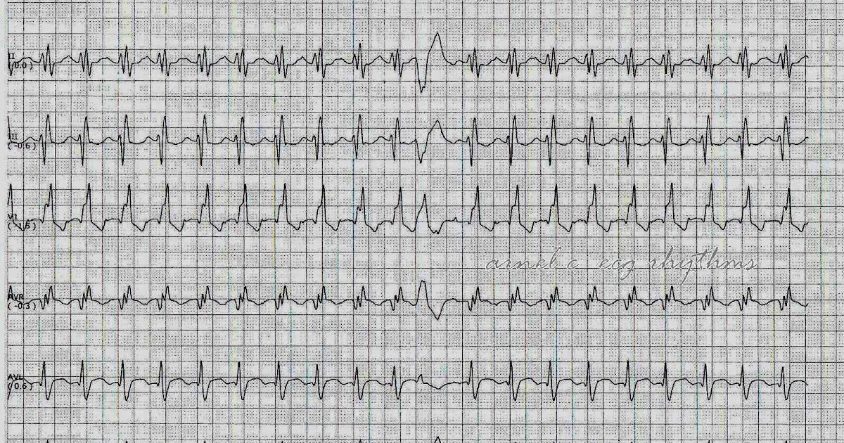 ECG Rhythms Utility of a PVC in Arrhythmia Diagnosis