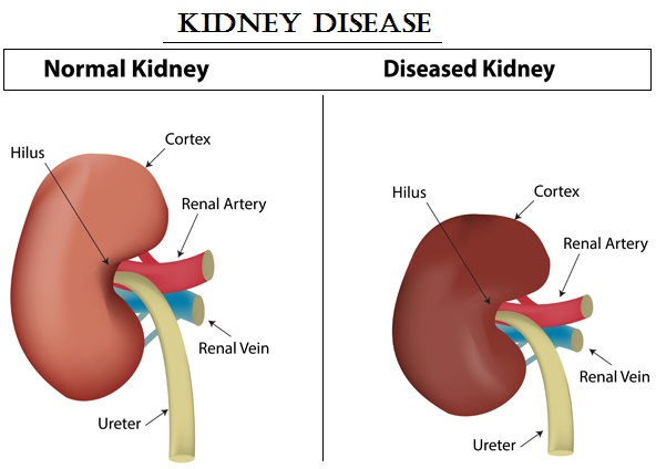 Kidney Disease and Diabetes | Diabetasol