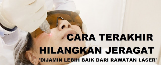 cara terakhir hilangkan jeragat tanpa rawatan laser cara terakhir hilangkan jeragat tanpa rawatan laser