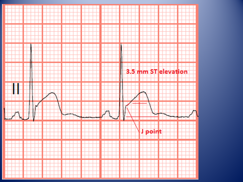 Telemetry Technician Course: Measuring ST Elevation and Depression