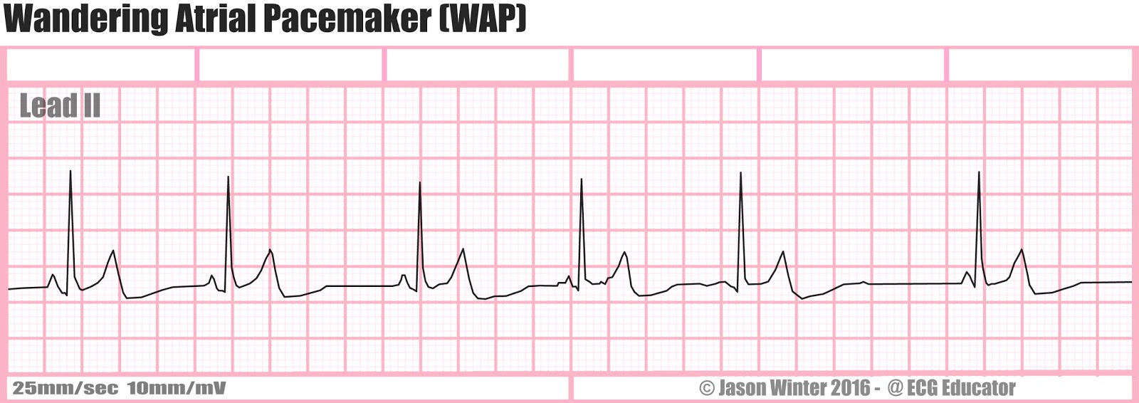 medical term wandering atrial pacemaker