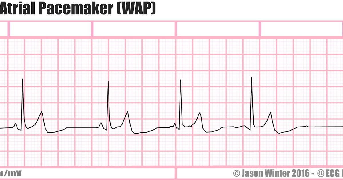 wandering pacemaker p wave