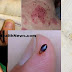 Get Rid Of Bed Bugs Forever Using These Tips