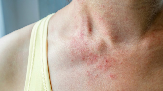 이미지에 대체텍스트 속성이 없습니다; 파일명은 Eczema-flare-1296X728-gallery_slide2-2.jpg 입니다.
