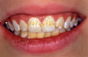 remover-manchas-dentes