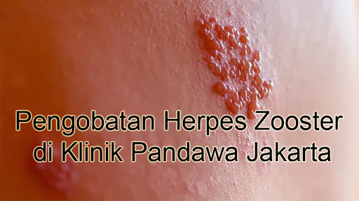 Pengobatan Herpes Zooster di Klinik Pandawa Jakarta