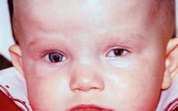 Анофтальм. Врожденный микрофтальм. Врожденная микрокорнеа. Микрофтальм глаза у ребенка. Микрофтальмия у новорожденных.