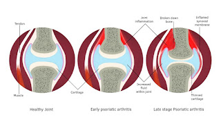 Psoriatic Arthritis types of arthritis