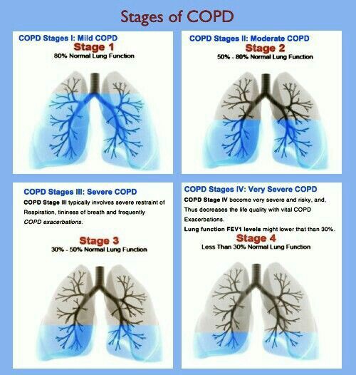 Medical and Health Science Stages of COPD!!!
