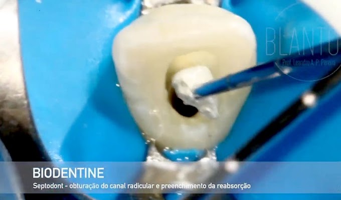 BIODENTINE: O substituto dentinário bioativo que revoluciona sua prática