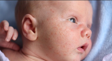 How to Treat Baby Acne You Must to Know - Feedtheking