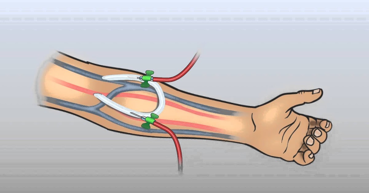 MEDICINE The arteriovenous (AV) graft part 1