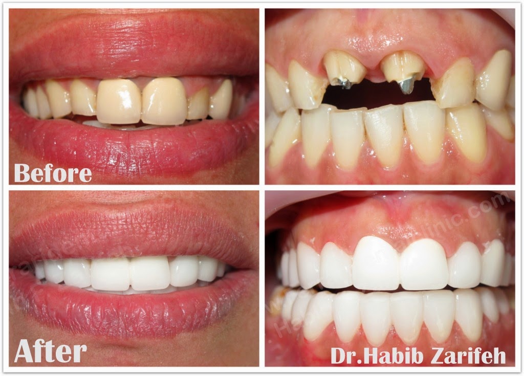 Hollywood smile Emax veneers in Lebanon by Dr.Habib Zarifeh the