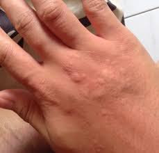 Image Ciri Ciri Penyakit Biduran