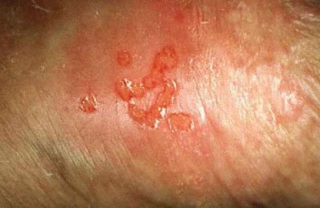 Skin Allergy - ACAAI Public Website