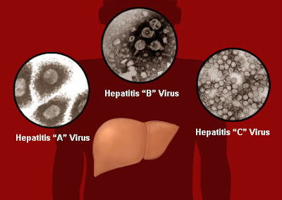 Obat Hepatitis Tradisional, Ampuh Menyembuhkan Hepatitis Secara Alami Obat Hepatitis Tradisional, Ampuh Menyembuhkan Hepatitis Secara Alami