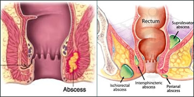 abses anus