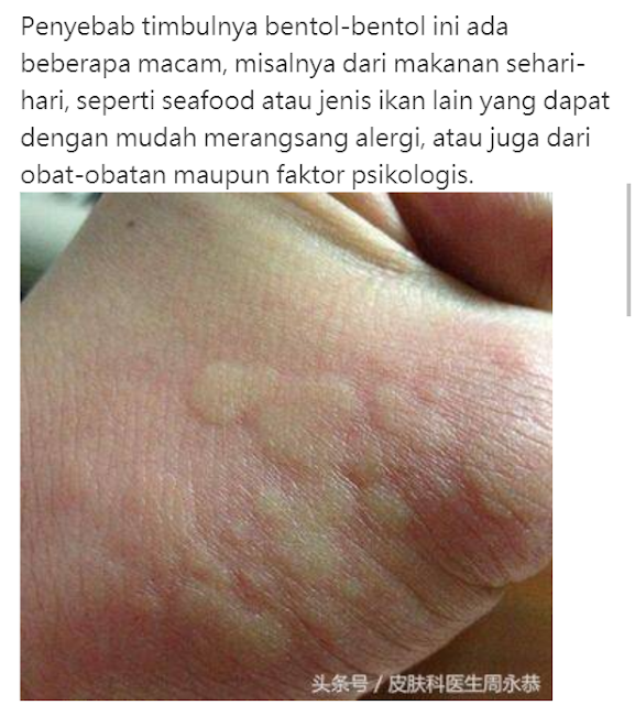 Kulitmu Sering "Bentolbentol" Bahkan "Gatal" Tibatiba?? Ternyata "Ini