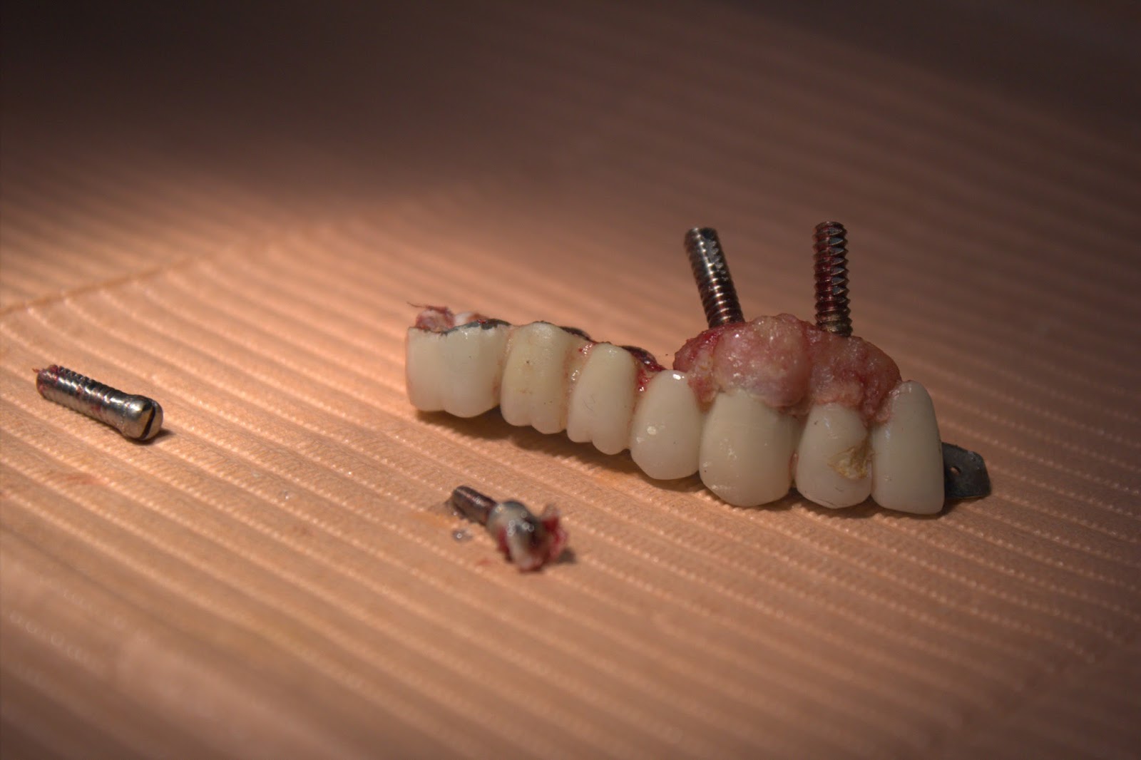 Chinthamani Laser Dental Clinic: FAILED DENTAL IMPLANTS- HOW TO PROCEED