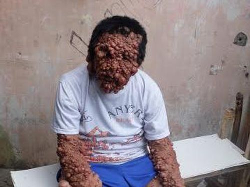 Hati-hati! Tumor Jenis Inilah yang Menutupi Tubuh & Wajah Suadji Hati-hati! Tumor Jenis Inilah yang Menutupi Tubuh & Wajah Suadji