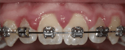 Kendinden bağlanan braketler ile elastik ligatür karşılaştırması. Fotoğrafın sol tarafındaki yan kesici dişteki geleneksel braketi ve elastik halkayı görmekteyiz.(4) 
