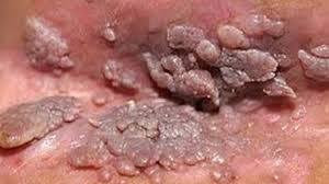 Obat Alami Kutil Kelamin Obat Alami Kutil Kelamin