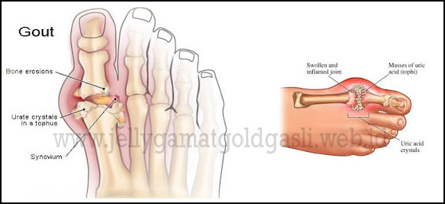 Obat Mujarab Untuk Gout Obat Mujarab Untuk Gout