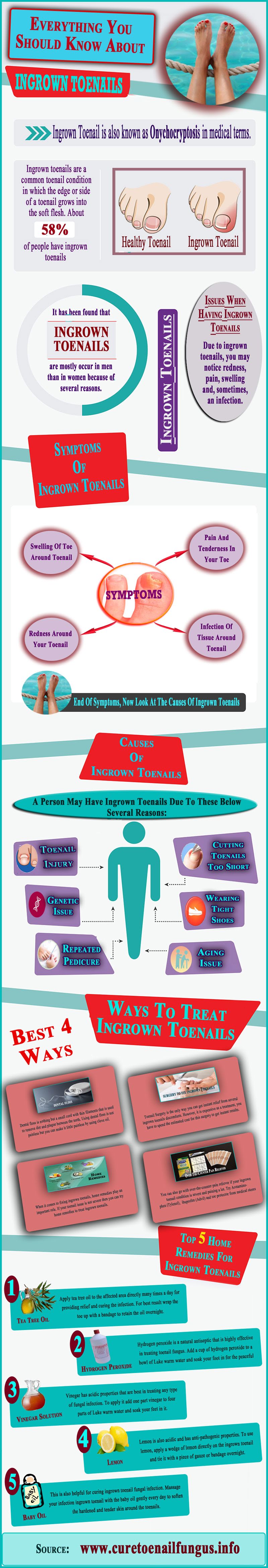 Everything You Should Know About Ingrown Toenails #Infographic #Nails #Health Everything You Should Know About Ingrown Toenails