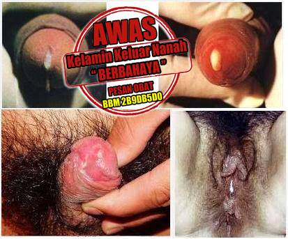 Obat Kencing Nanah Alami Pengobatan 3 - 5 Hari Sembuh Obat Kencing Nanah Alami Pengobatan 3 - 5 Hari Sembuh