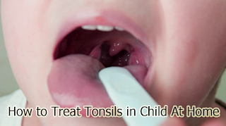 How to Treat Tonsils in Child At Home