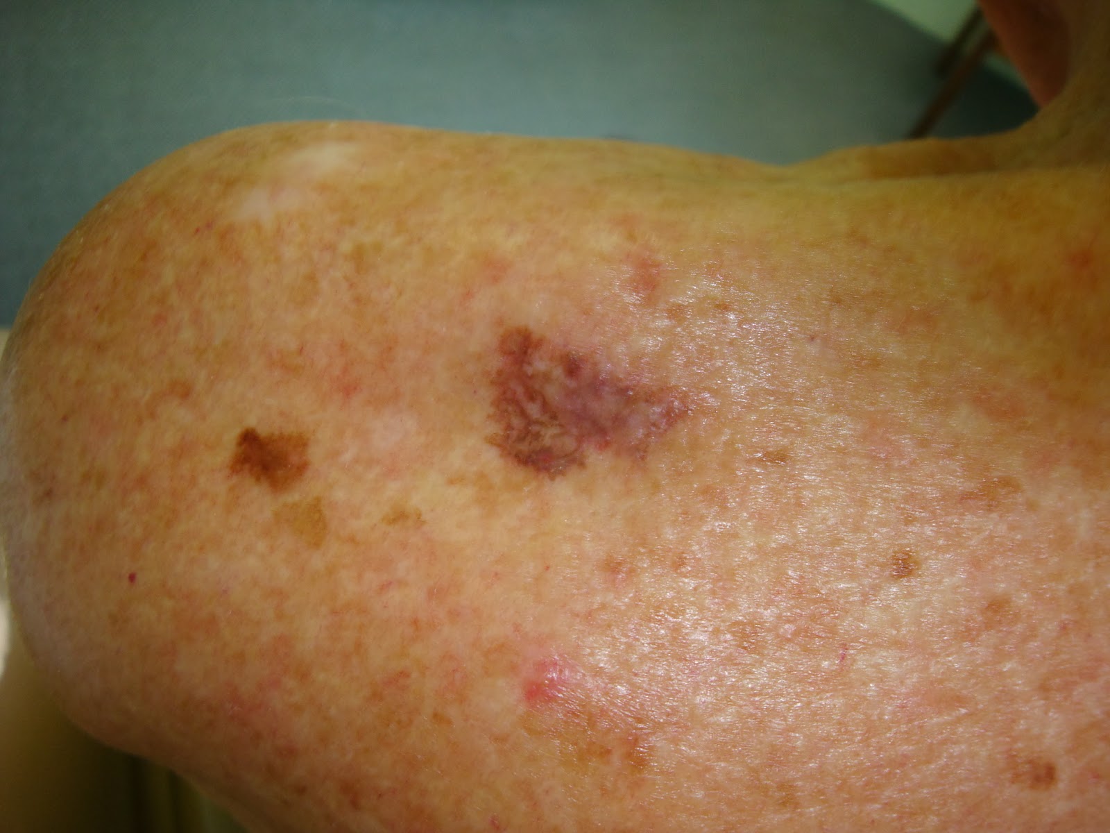 Acral lentiginous melanoma | DermNet New Zealand
