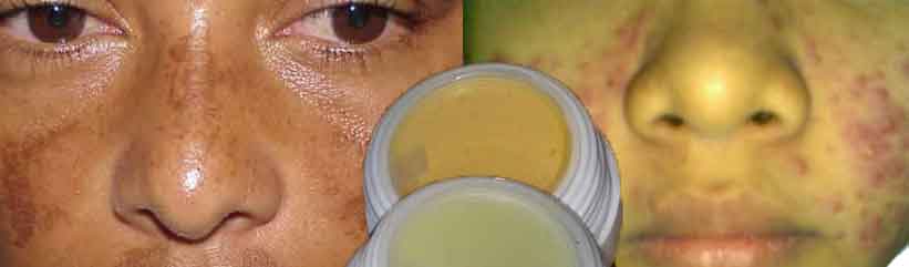Efek Buruk Kosmetik Yang Mengandung Bahan Berbahaya