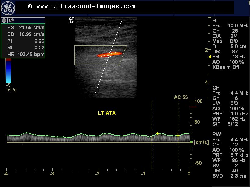Ultrasound imaging: Color Doppler study of severe arterial..