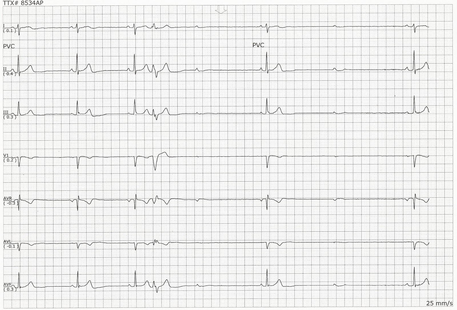Sinus bradycardia changing to second degree heart block type II