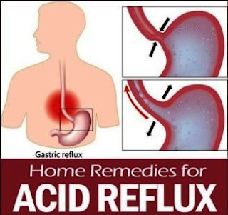 Controlling Acid Reflux Using Natural Home Remedies