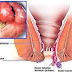 Obat Ambeien Menurut Resep Dokter thumbnail