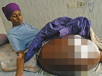 Obat Herbal Benjolan di Betis Kaki atau Tangan Terampuh Obat Herbal Benjolan di Betis Kaki atau Tangan Terampuh