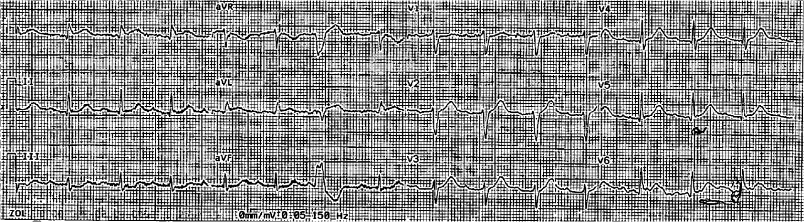 Dr. Smith's ECG Blog: Look at the PVCs (again)!!