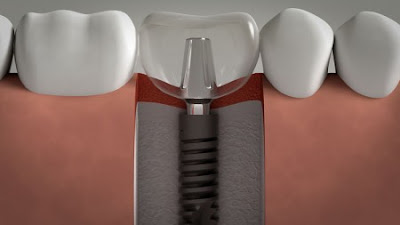 Trồng răng giả bằng cấy ghép Implant