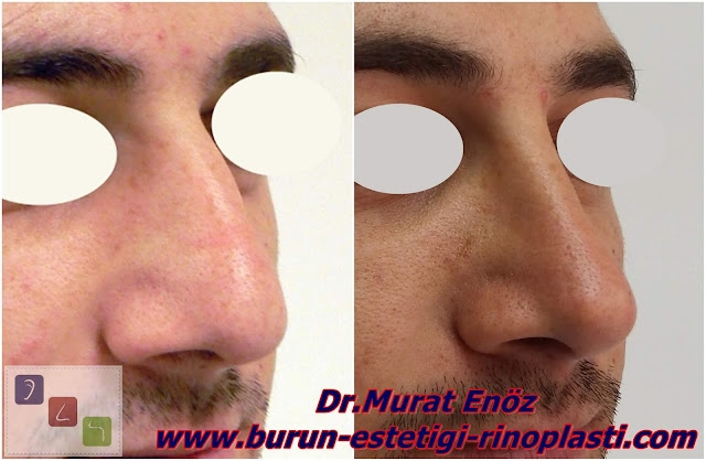 Erkek Burun Estetiği Öncesi ve Sonrası Fotoğrafları Erkek Burun Estetiği Öncesi ve Sonrası Fotoğrafları