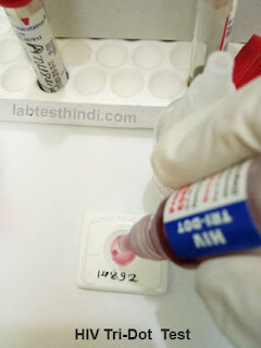 HIV test -- Add 2 drop Conjugate liquid