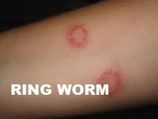 ringworm Monsoon Skin Care in Hindi
