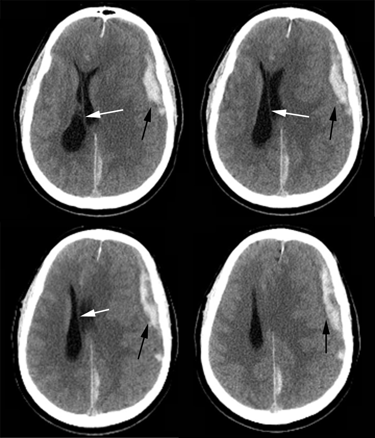 Acute ischemic stroke ct. Scan left. Scan left. Менинговаскулярный сифилис. Ischemic stroke ct.