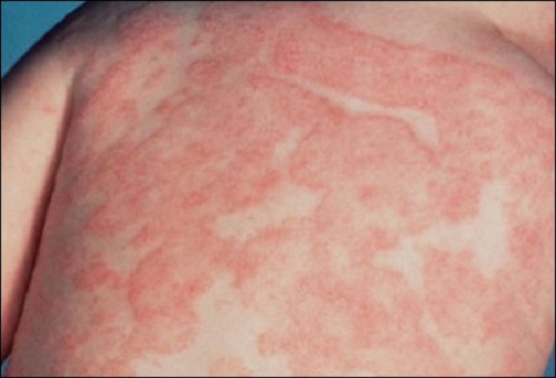 chàm bội nhiễm và cách chữa trị bệnh chàm bội nhiễm và cách chữa trị bệnh