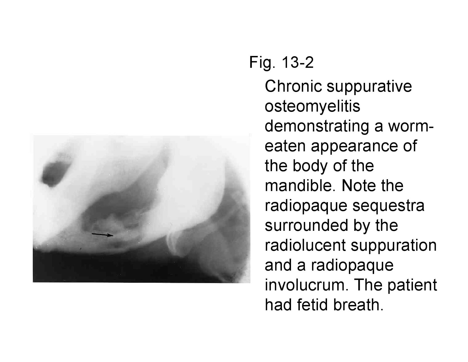 Dentistry and Medicine Osteomyelitiswith Radiological features