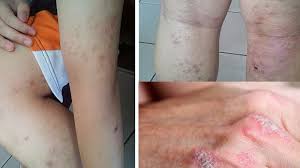 obat jamur gatal selangkangan dan pantat yang ampuh