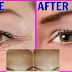 3 Steps Treatment In Eliminating Wrinkles On Your Face To Achieve Younger Glowing Skin
